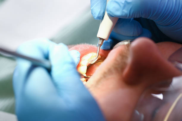 Best Emergency Dentist for Lost Fillings or Crowns in Fairfield, IA