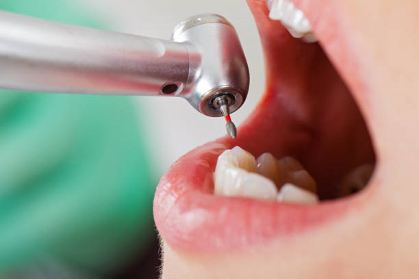 Best Emergency Dentist for Knocked-Out Tooth in Fairfield, IA